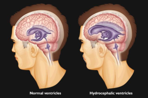 Understanding Legal and Ethical Aspects of Hydrocephalus Surgery in India