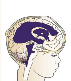 How Neurosurgeons Manage Complex Hydrocephalus Cases