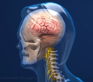 Understanding When Surgery Is Necessary for Chiari Malformation