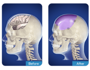 Causes That Lead to the Need for Cranioplasty Surgery in India