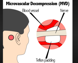 Are There Risks with MVD Surgery? Understanding the Potential Complications