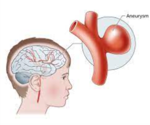 Recognizing Aneurysm Symptoms and the Importance of Early Diagnosis