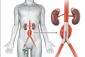 Understanding How Endovascular Repair Treats Aneurysms