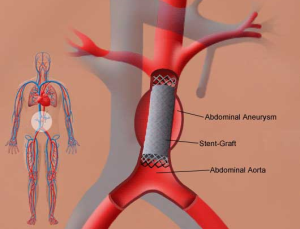 Key Indicators That Aneurysm Repair Surgery May Be Necessary