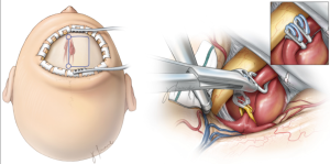 A Comprehensive Guide to Brain Aneurysms and Their Surgical Solutions