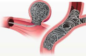 Exploring Non-Surgical Options for Aneurysm Treatment