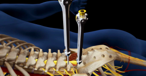 How Spinal Cord Surgery Provides Lasting Relief for Herniated Discs