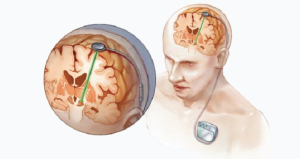 Essential Post-Operative Care Guidelines for Deep Brain Stimulation (DBS)