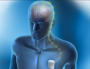 Understanding the Risks and Side Effects of Deep Brain Stimulation