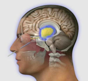 Understanding the Cost of Skull Base Surgery in India