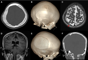 How Skull Base Surgery Helps Treat Meningiomas