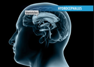 Determining the Need for VP Shunt Surgery in Hydrocephalus Patients