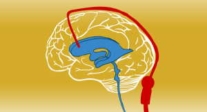 Understanding the Risks and Complications of VP Shunt Surgery