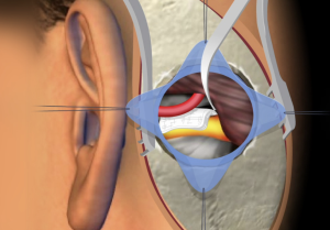 Understanding Microvascular Decompression for Trigeminal Neuralgia