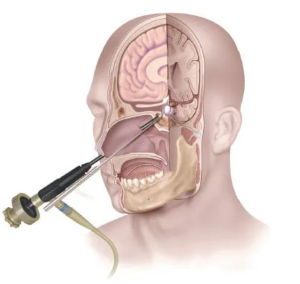 Pituitary Tumor Surgery in India