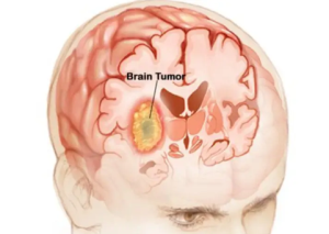 Brain Tumor Surgery in India