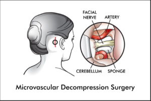 Microvascular Decompression (MVD) Surgery in India