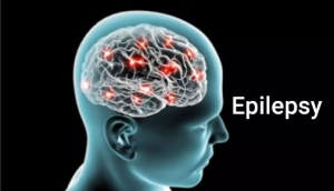 Epilepsy Surgery in India