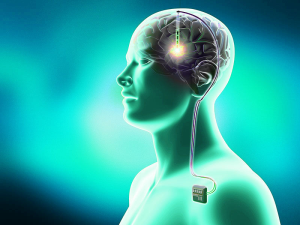 Deep Brain Stimulation (DBS) Surgery in India