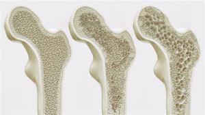 Understanding the Importance of Bone Health Post-Cancer Treatment