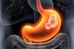 Latest Advances in Stomach Cancer Treatment in India