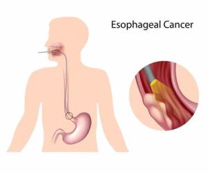 The Benefits of Minimally Invasive Surgery for Esophageal Cancer