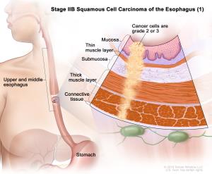 Understanding Survival Rates for Esophageal Cancer Patients