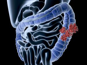 How Age and Gender Impact Colon Cancer Risk