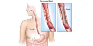 Advances in Esophageal Reconstruction After Cancer Surgery