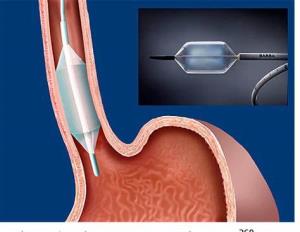 Role of Endoscopic Procedures in Esophageal Cancer Management