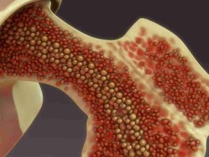 The Role of Biopsies in Confirming Bone Cancer Diagnosis