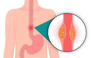 Esophageal Cancer and Its Impact on Breathing and Digestion