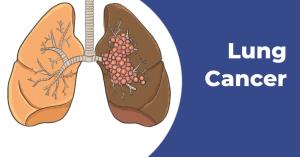 Introduction to Lung Cancer