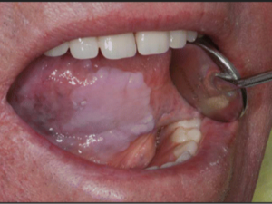 Advanced Oral or Mouth Cancer: Unresectable, Recurrent, and Metastatic Disease