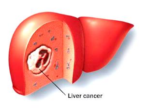 Advanced Liver Cancer Treatment in India