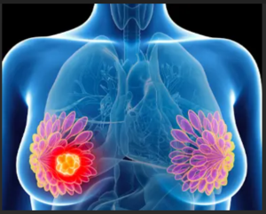 Best breast cancer treatment in India