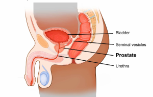 Best Prostate Cancer Treatment in India