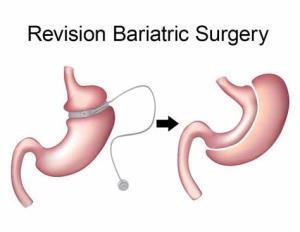 Exploring the Latest Research on Revision Bariatric Surgery