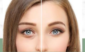 Understanding the Different Techniques of Blepharoplasty