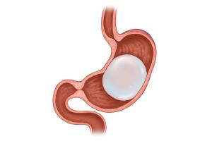 Potential Risks and Complications of Intragastric Balloon Treatment