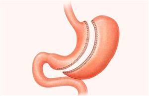 Risks and Complications Associated with Sleeve Gastrectomy