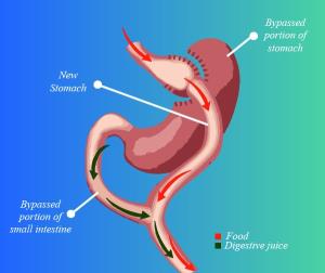 Innovations in Mini Gastric Bypass Surgery Techniques