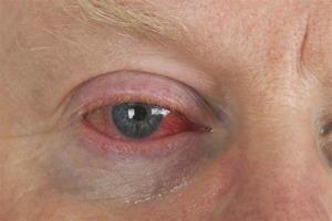 Eyelid Surgery as a Solution for Chronic Eye Fatigue