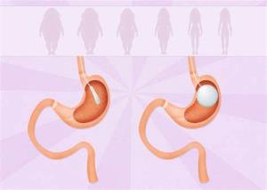 The Role of Physical Activity in Enhancing Intragastric Balloon Results