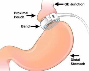 How Does the Gastric Band Work