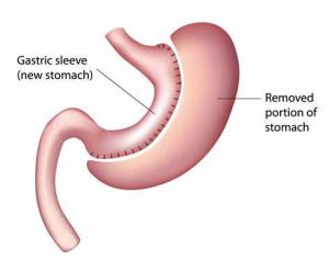 Post-Surgery Diet Tips for Sleeve Gastrectomy Patients