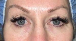 Understanding the Longevity of Eyelid Surgery Results