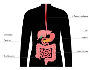 Managing Digestive Changes After Biliopancreatic Diversion with Duodenal Switch Surgery