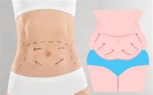 How Obesity Can Lead to the Need for a Tummy Tuck