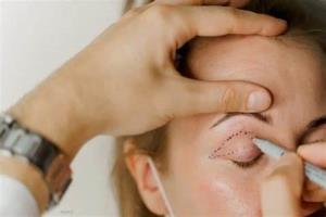 Eyelid Surgery and Its Impact on Nonverbal Communication